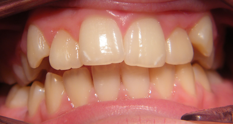 veneers downpatrick